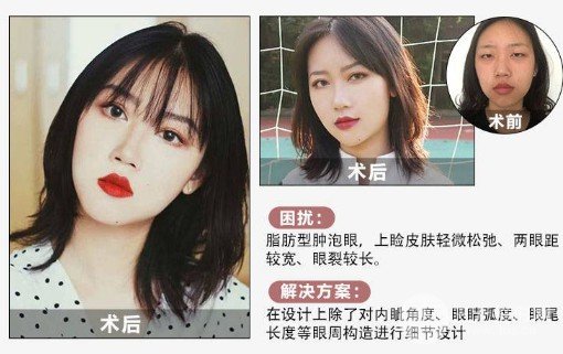 双眼皮手术后恢复期