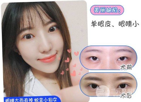 双眼皮手术后恢复期