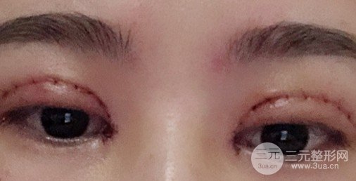 双眼皮手术后恢复期
