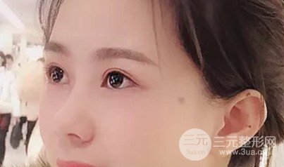 双眼皮手术后恢复期