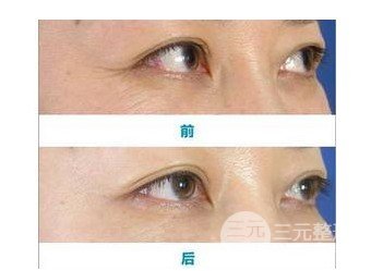 除鱼尾纹针多少钱