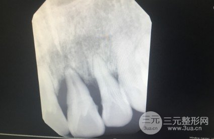雅美牙科种植牙案例