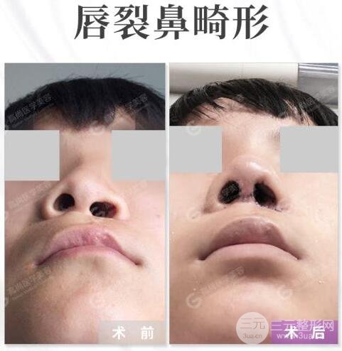 唇裂修复成功图片