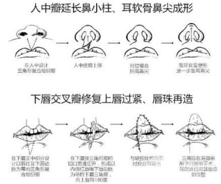唇裂修复成功图片