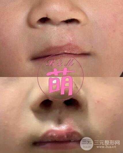 唇裂修复应该注意的事项