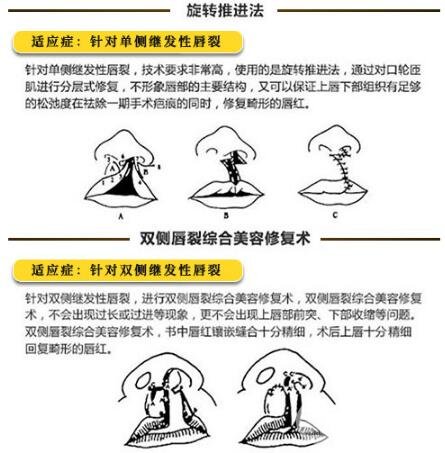 整形医生讲解唇裂修复手术