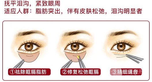 眼袋切除术需要多少钱