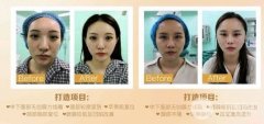 面部轮廓提升果图片，堆护肤品不如认真做1次提升