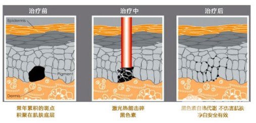 激光祛黄褐斑多久可以恢复