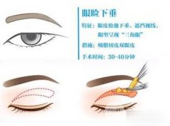 眼睑吸脂前后对比，肿眼泡“瘦了”好多