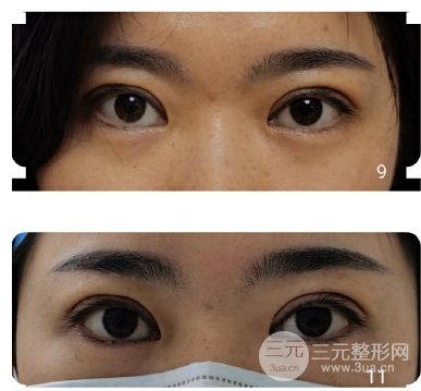 眼睑吸脂前后对比