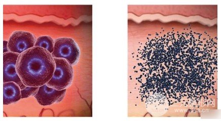 激光祛斑有果吗