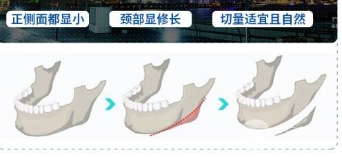 为什么切下颌角后脸还大?