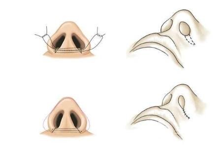 鼻头缩小手术原理
