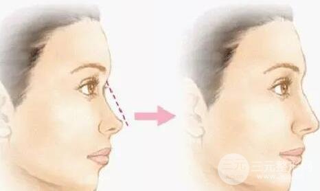 鼻部难整形是哪个部位?