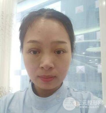 双眼皮失败的八种图片