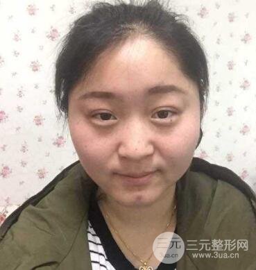 双眼皮失败的八种图片