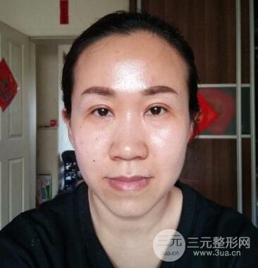 双眼皮失败的八种图片