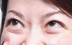 去眼袋有的土方法是什么？真的有果吗？