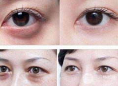 快速消除眼袋的小妙招有哪些？赶紧学起来！