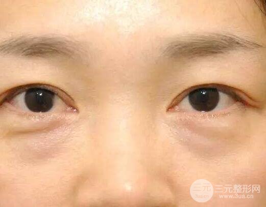 快速消除眼袋的小妙招