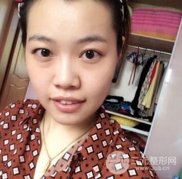 快速消除眼袋的小妙招