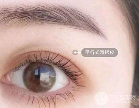 较好看的四种双眼皮