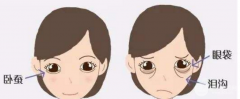 假性眼袋什么样子图？怎么去除眼袋？