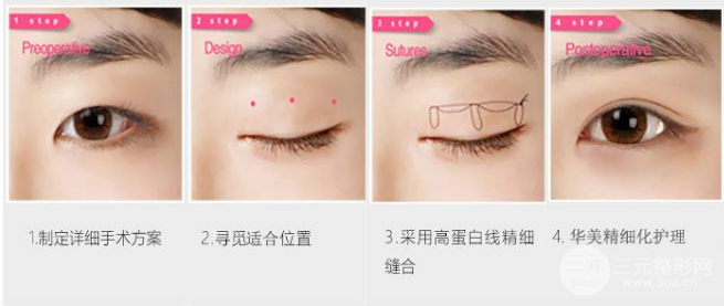割双眼皮有哪些风险