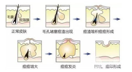 激光缓解痤疮会复发吗