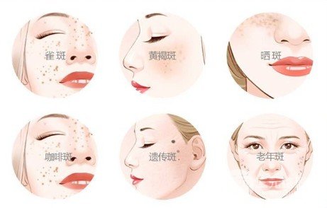 蜂巢激光祛斑恢复