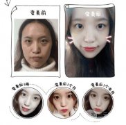 用什么可以【基本】去眼袋?手术方式都有哪些?