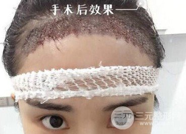女性植发的价格一般多少