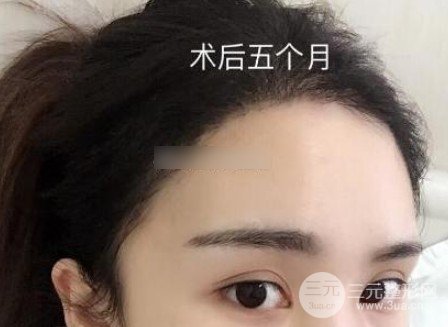 女性植发的价格一般多少