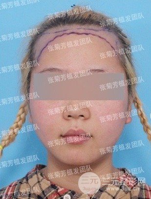 女性植发的价格一般多少