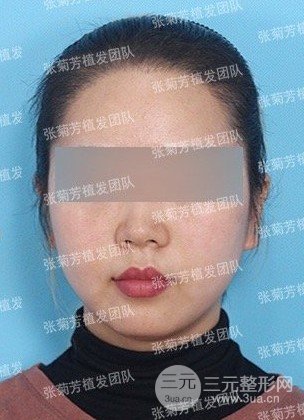 女性植发的价格一般多少