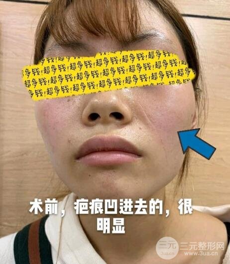 淮北市人民医院疤痕科祛疤案例