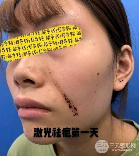 淮北市人民医院疤痕科祛疤案例