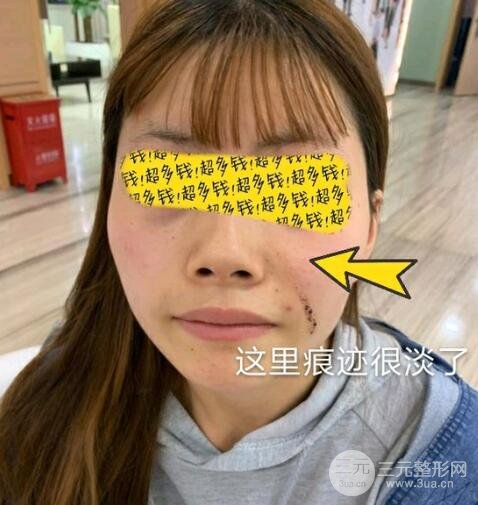 淮北市人民医院疤痕科祛疤案例
