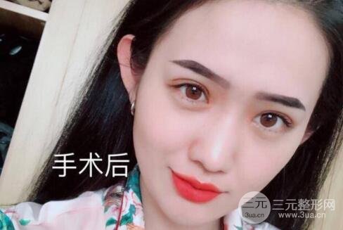 进行开眼角的手术