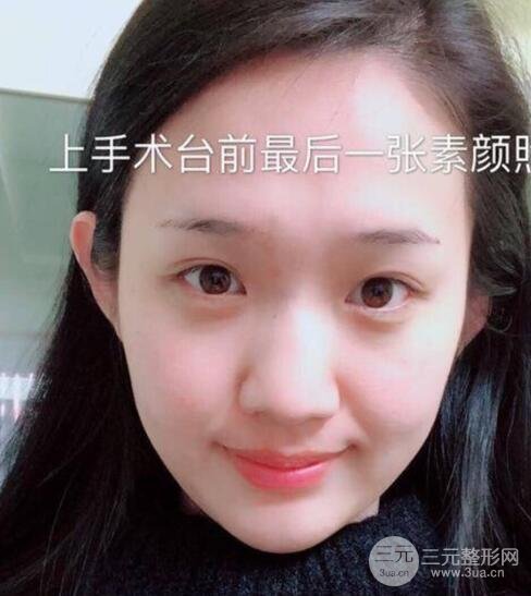 开眼角前后对比照片图