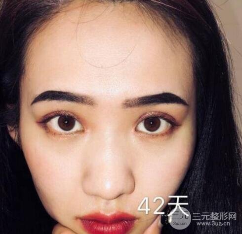 开眼角前后对比照片图