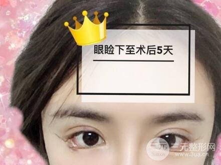 开眼角和眼角下至有什么不同?