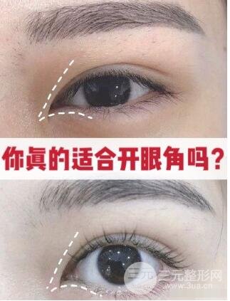 你真的适合开眼角吗?下面情况不适合