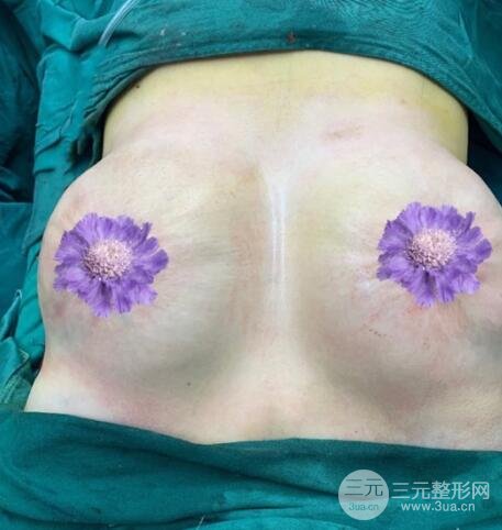 胸部太大带来的烦恼