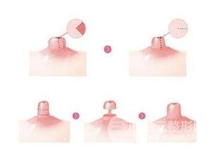 如何避免乳房缩小后的疤痕?