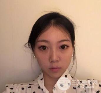 进行全切双眼皮的第一天