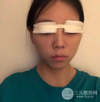 进行全切双眼皮的第一天