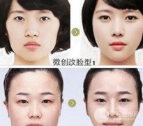 什么是微创改脸型？360科普手术，教你降低风险瘦脸！