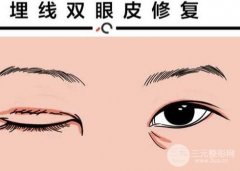 做埋线后老了的危害是什么？注意事项有哪些？